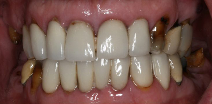Before — full upper arch missing all teeth