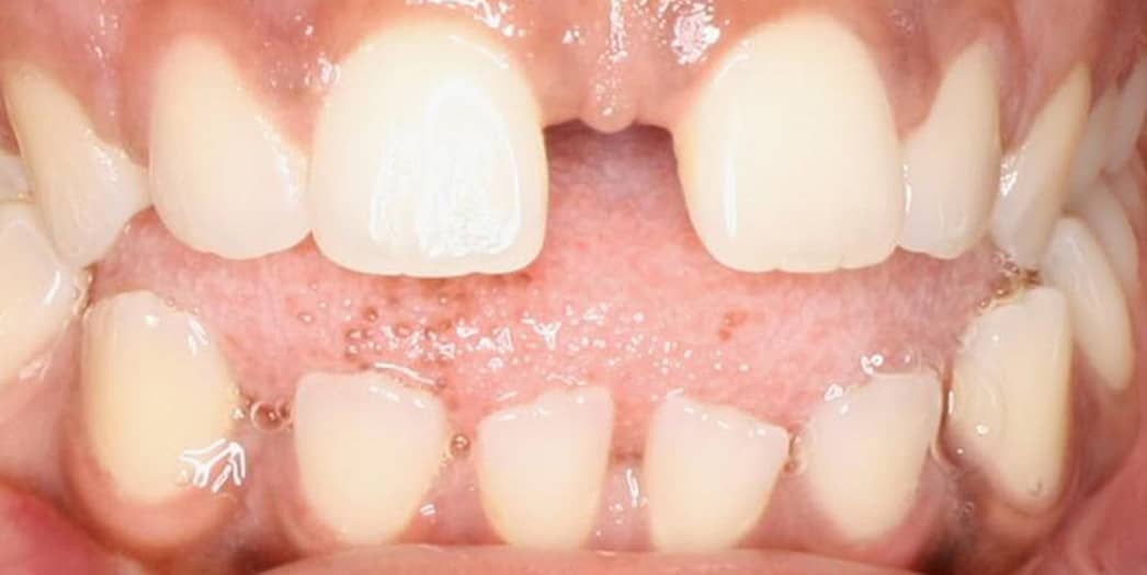 Before — yellowed, stained teeth