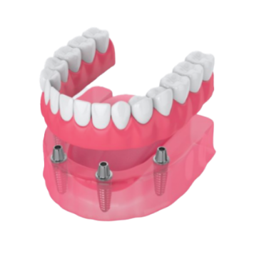Implant-supported dentures at Island Dental