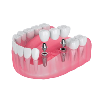Implant-supported bridge replacing multiple missing teeth