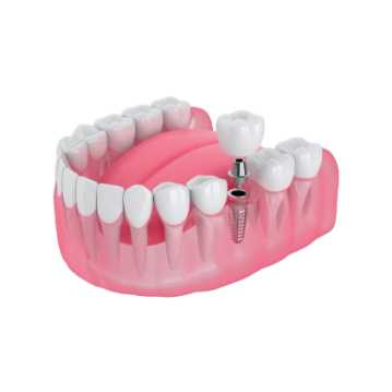 Cross-section of a dental implant showing the titanium post in the jawbone
