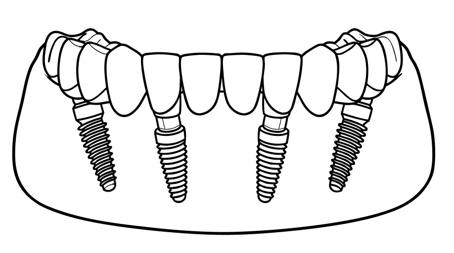 Illustration of a full arch supported by 4&ndash;6 implants