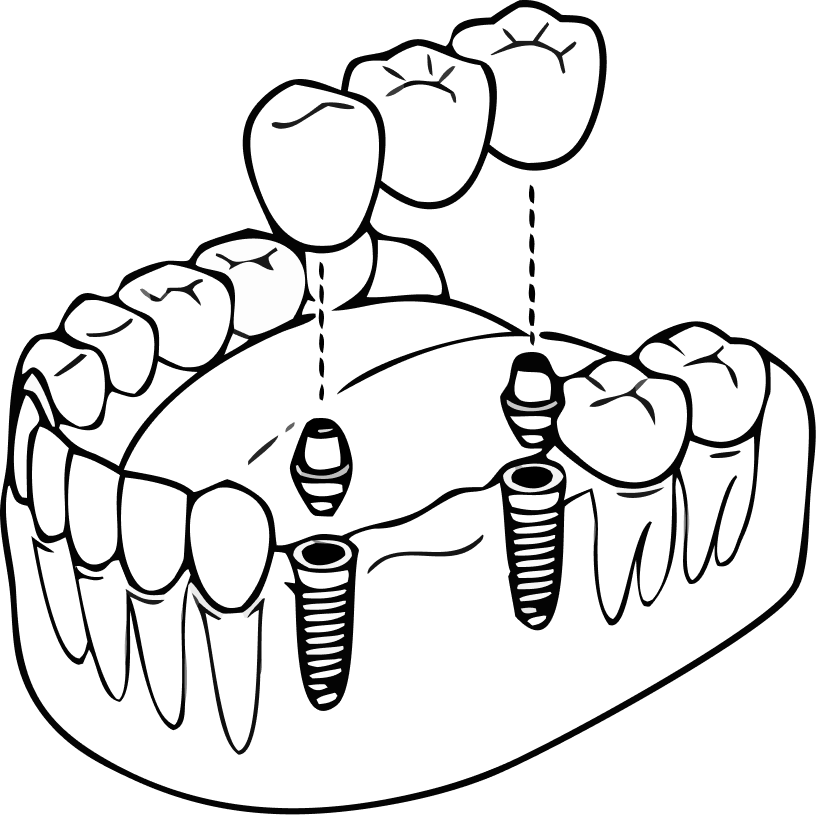 Illustration of an implant-supported bridge