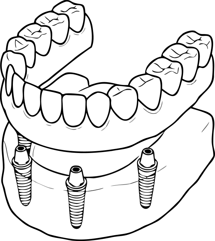 Illustration of a snap-on implant denture attachment system