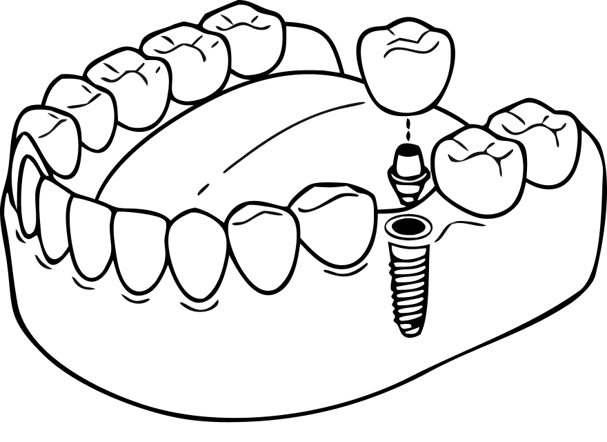 Illustration of a single dental implant with crown