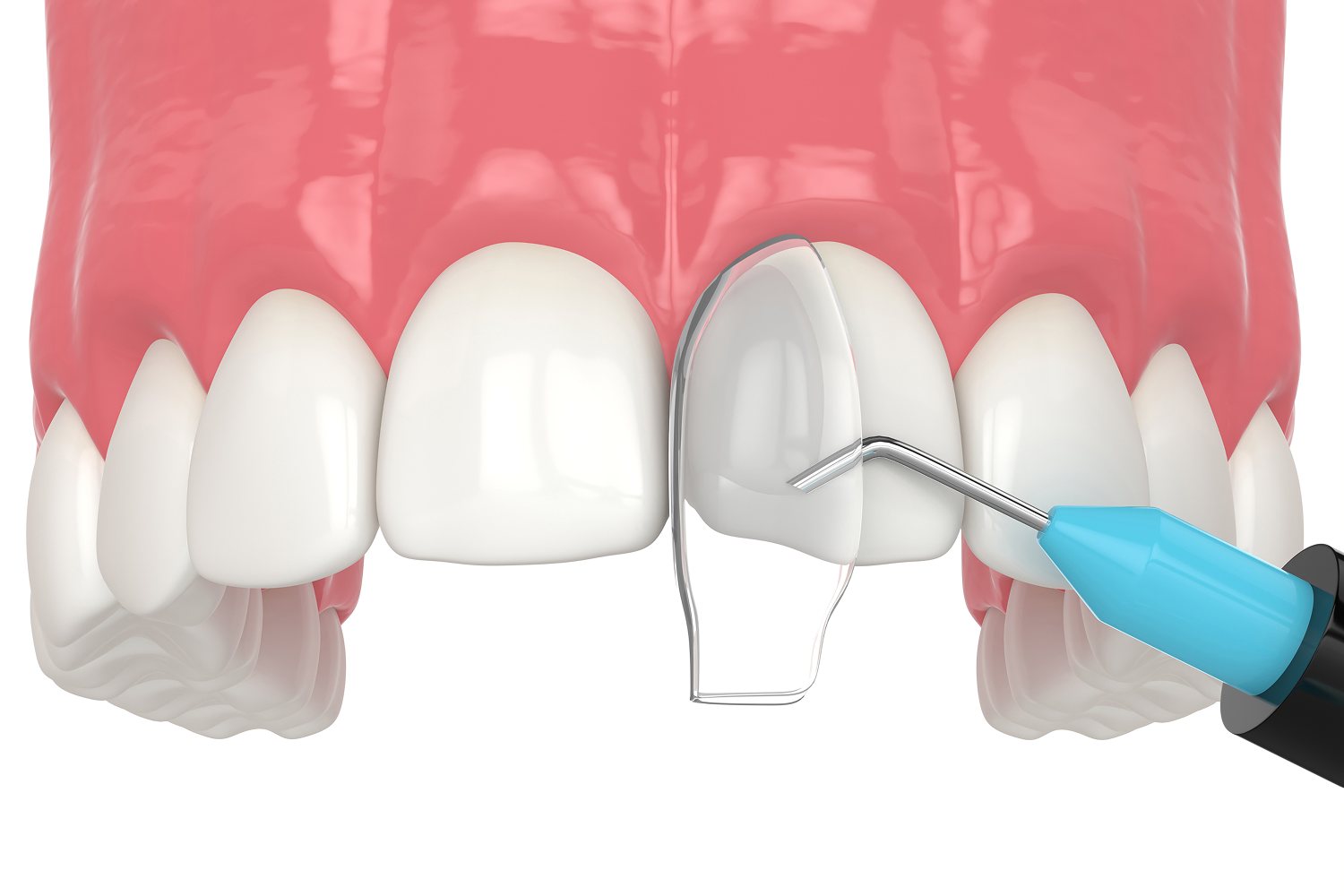 Dental bonding