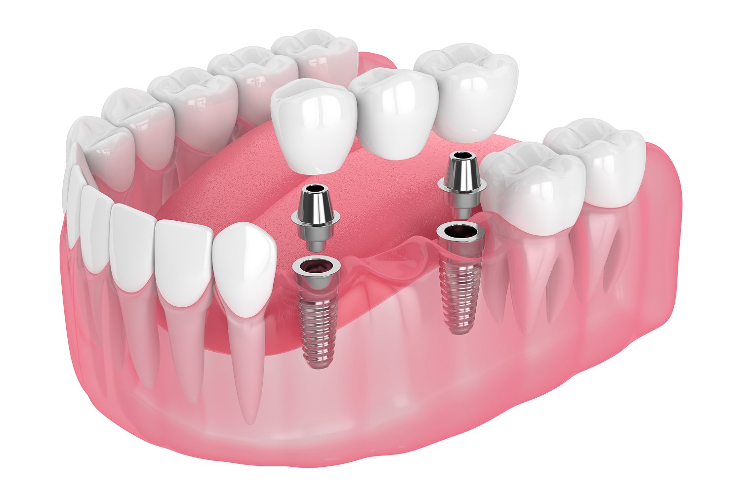 Dental implant