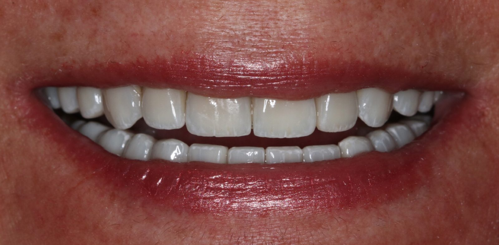 After — full smile reconstruction with crowns and bonding