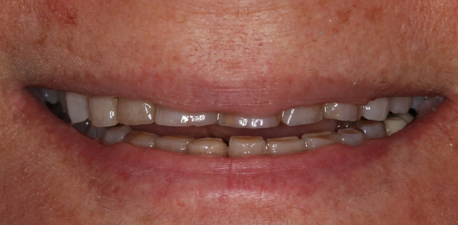Before — broken, worn teeth with gaps