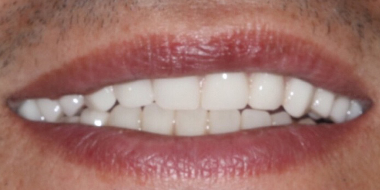 Implant-supported snap-on denture — stable, comfortable, confident smile