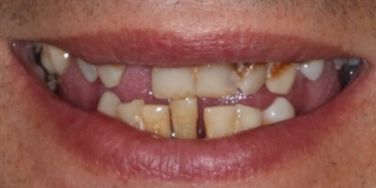 Loose lower denture, visible discomfort and bone loss