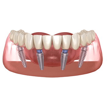 Full-arch implant restoration supported by multiple implants