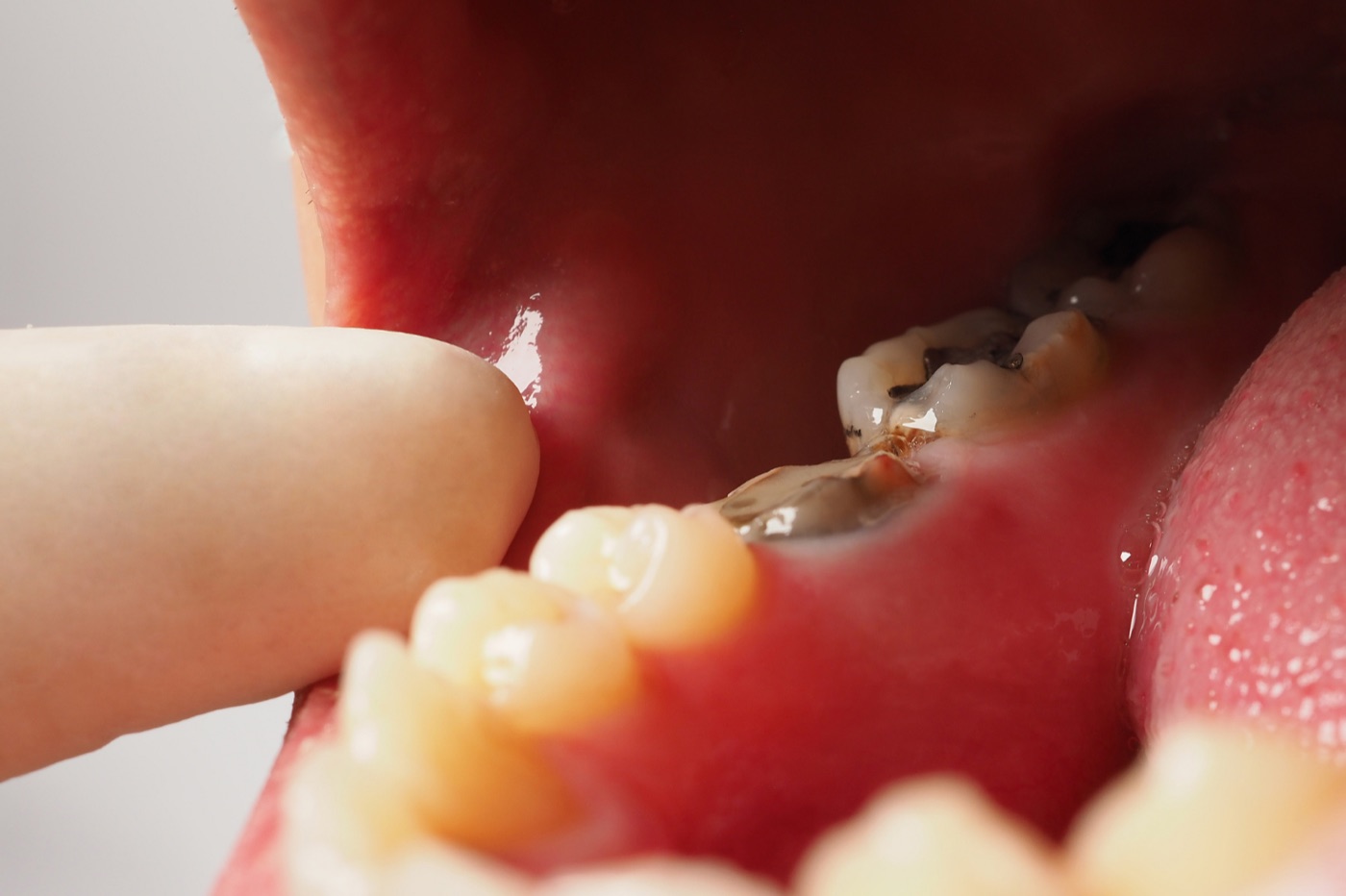 Dental abscess needs urgent care