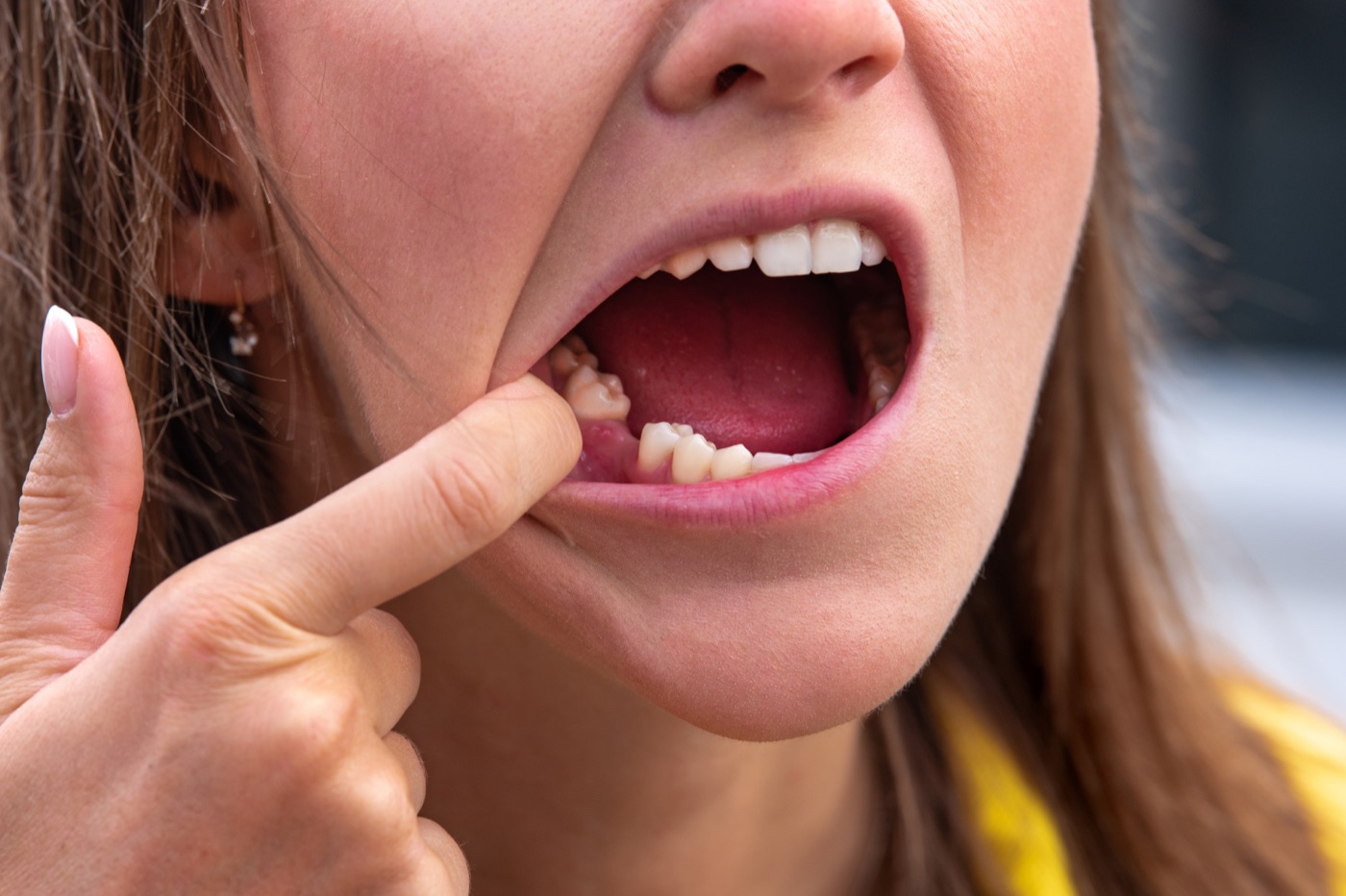 Knocked-out tooth first aid