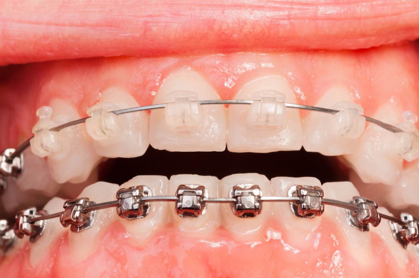 Clear ceramic and metal braces compared