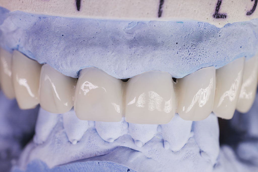 eMax porcelain restorations crafted in the Island Dental on-site lab