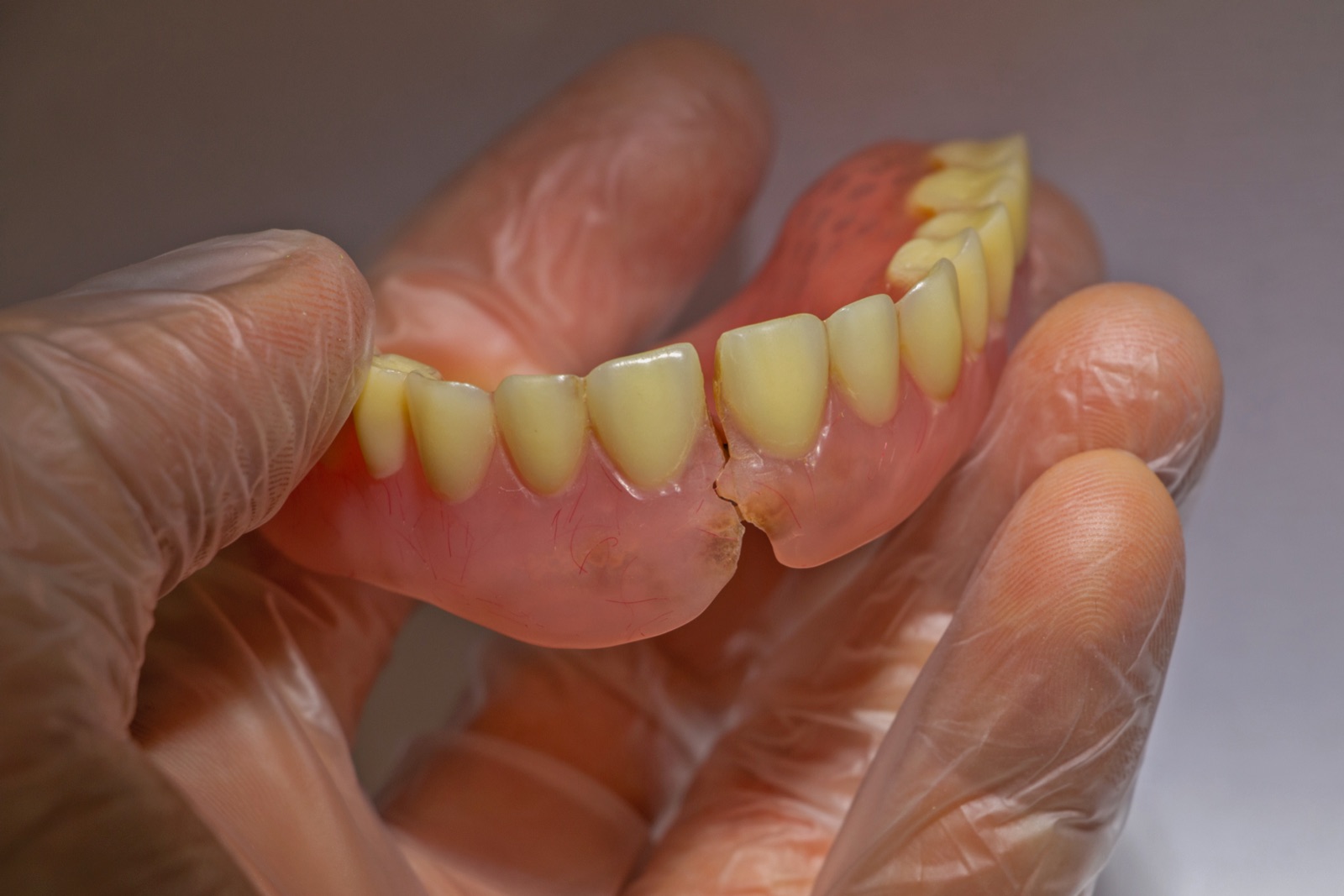 Broken denture → completed repair