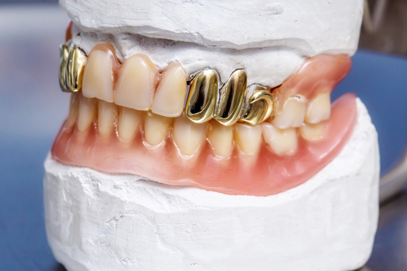 Gold alloy dental crown