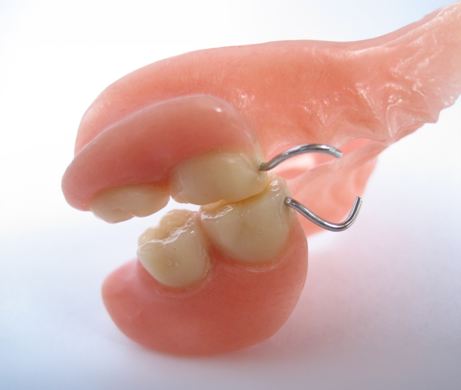 Custom partial denture crafted at Island Dental — natural-looking tooth replacement