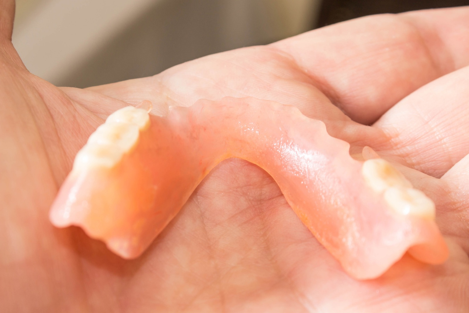 All-acrylic partial denture