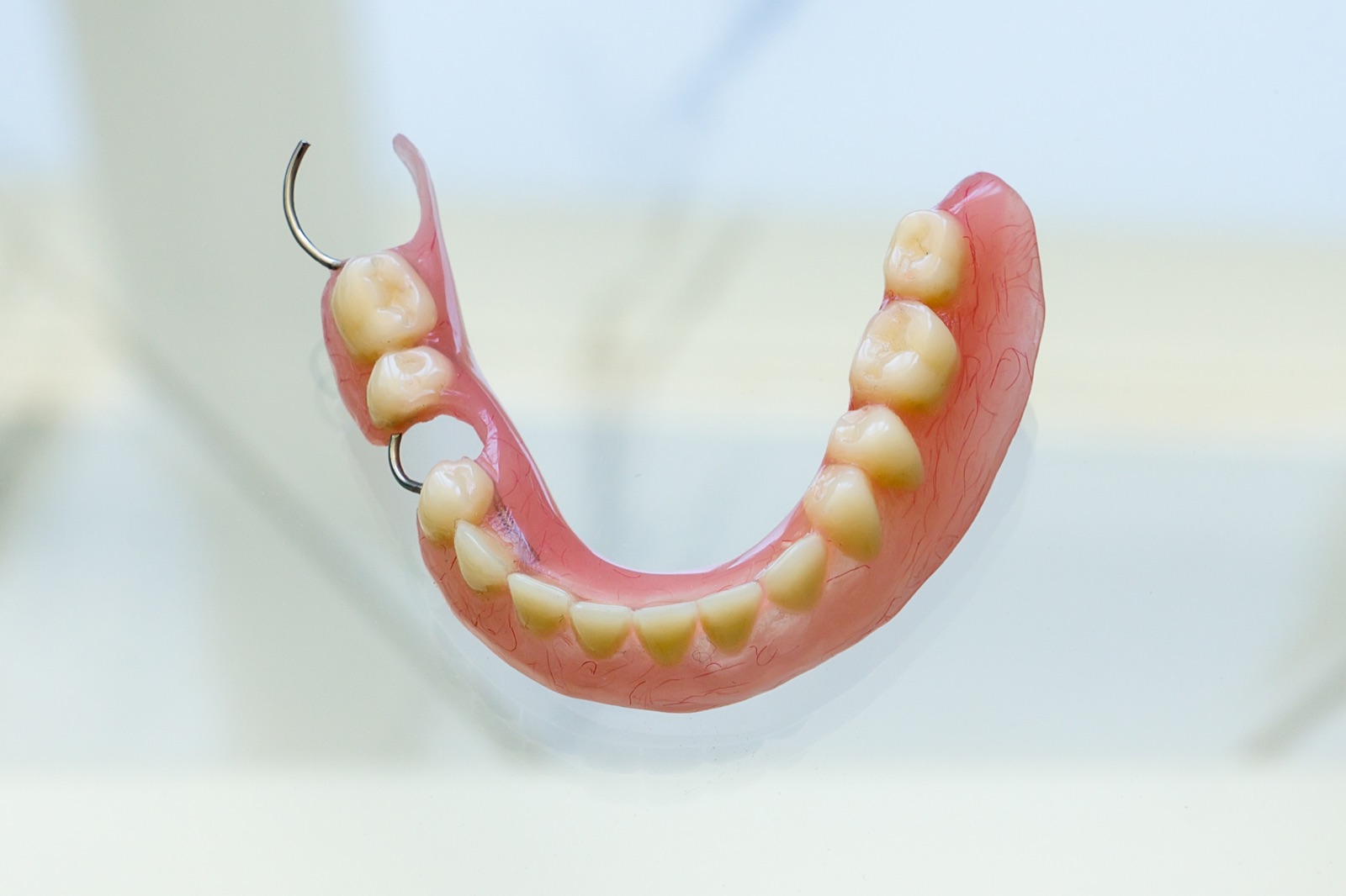 Cast metal partial denture with clasps