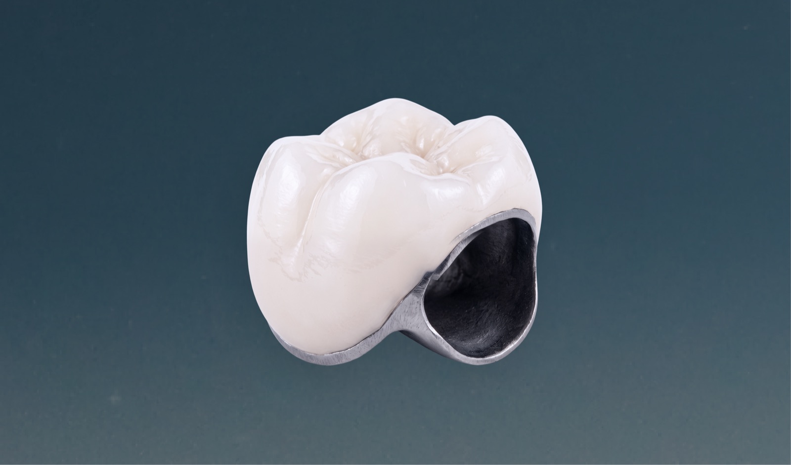 Porcelain-fused-to-metal dental crown