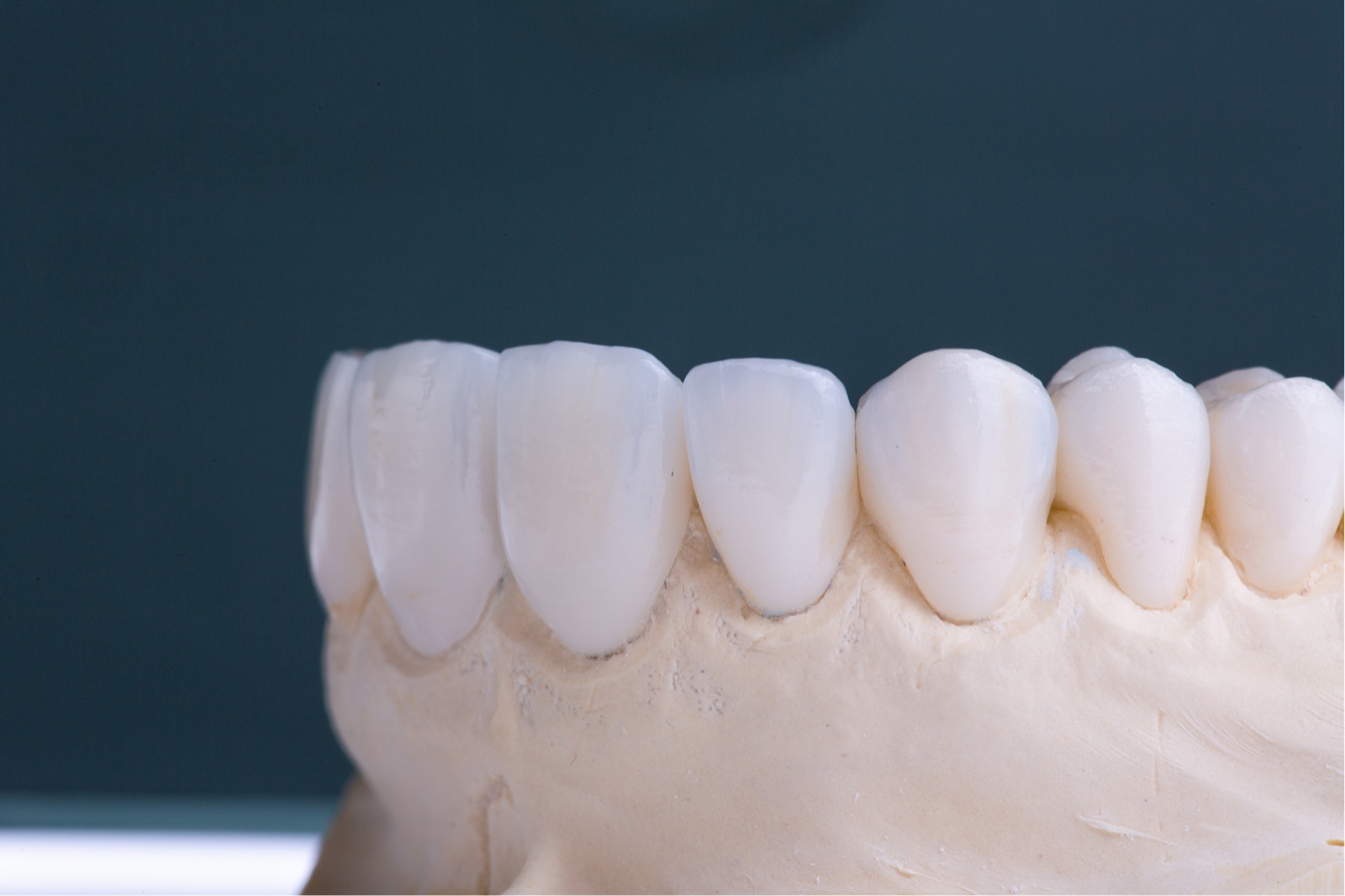 Zirconia dental crowns milled on site