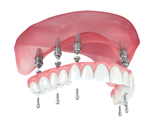 Fixed full-arch implant restoration illustration