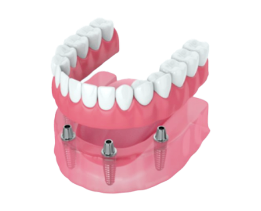 Snap-on denture attaching to dental implants