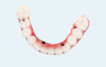 Screw-Retained Hybrid