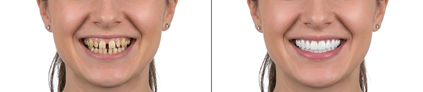 Porcelain veneers before and after