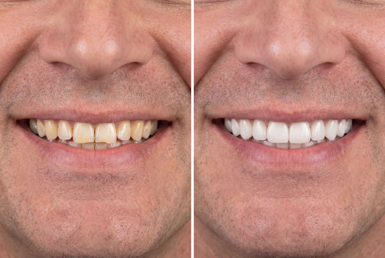 Before and after professional teeth whitening