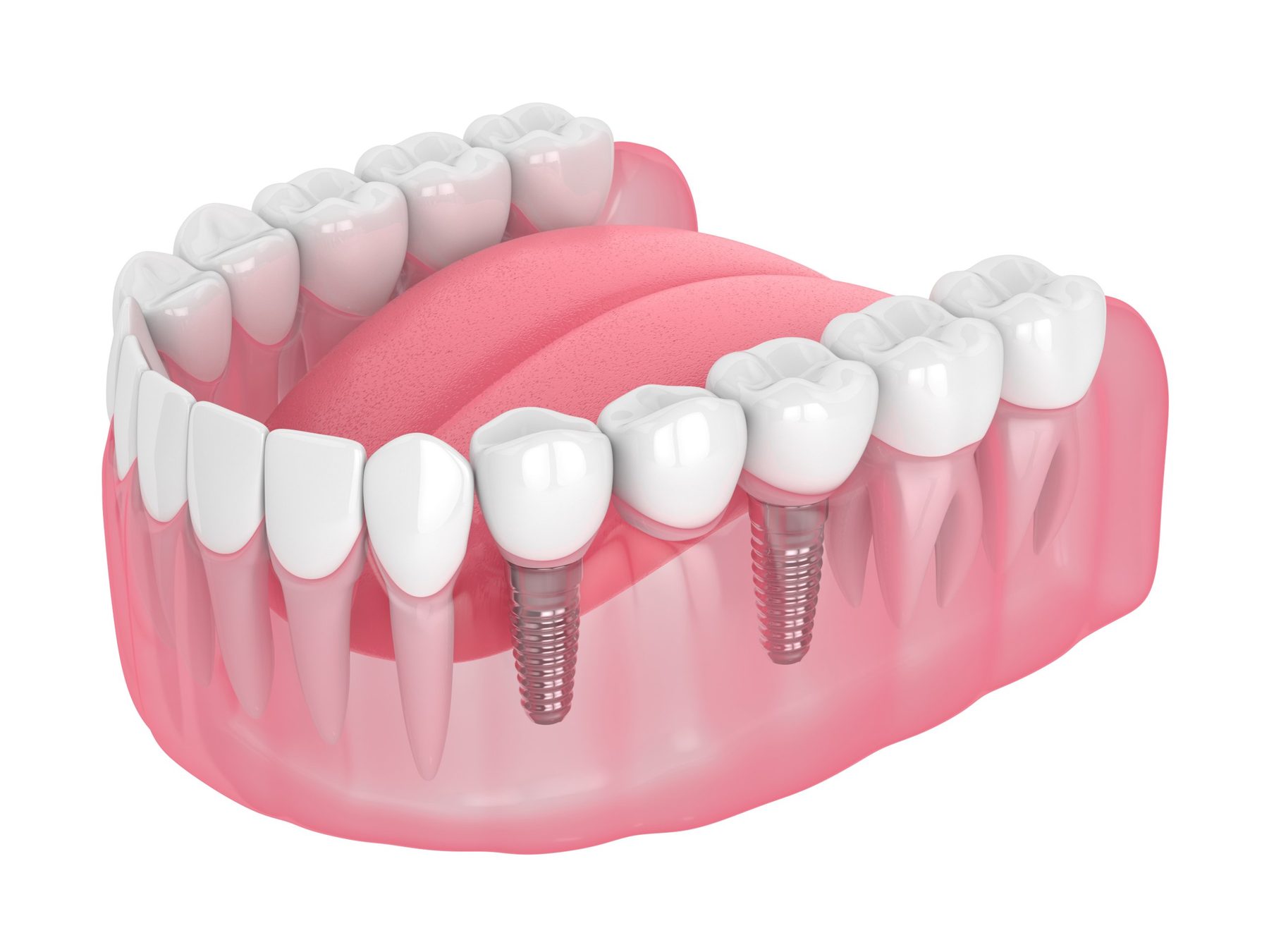 Implant-supported crown and bridge