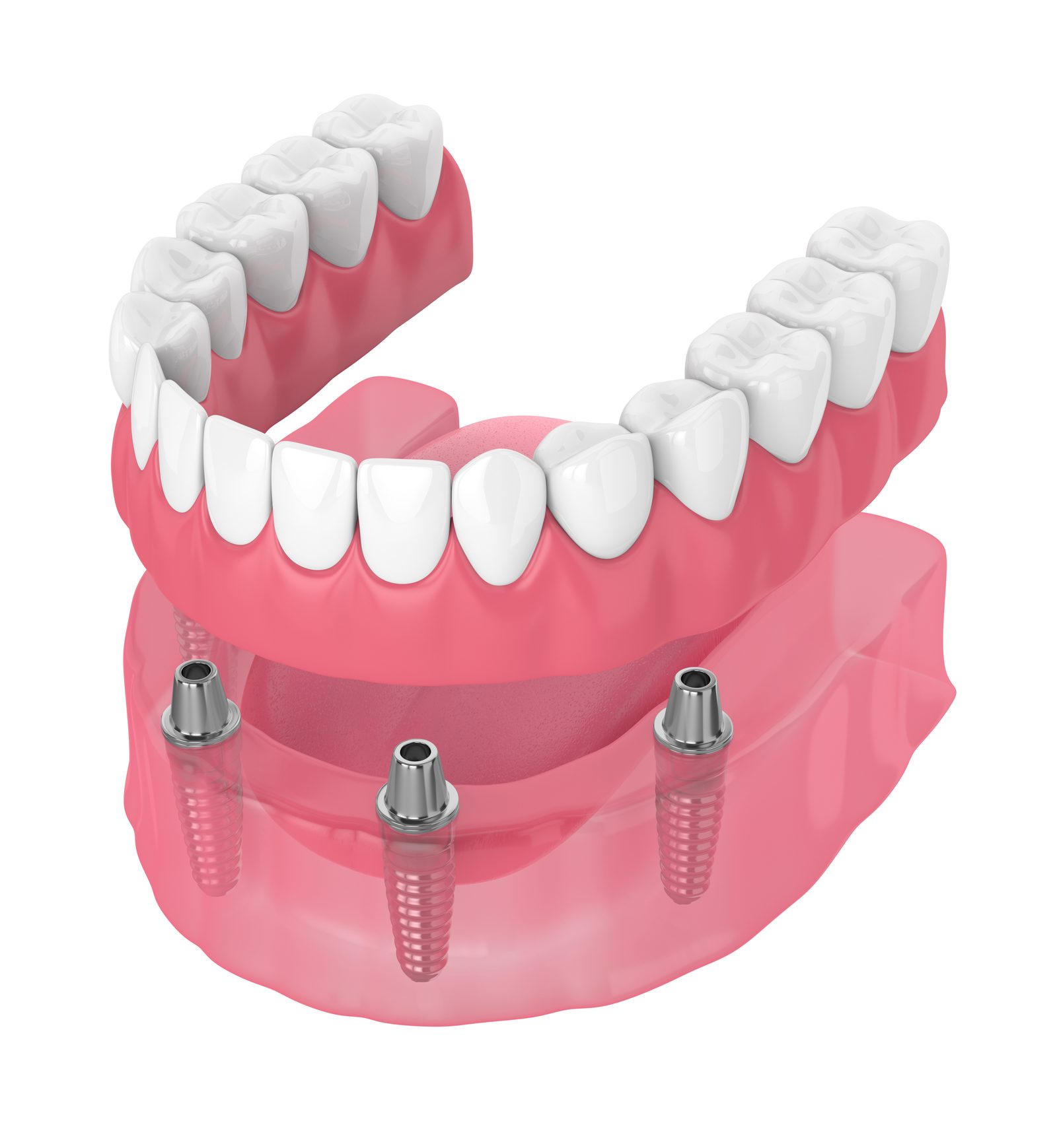 Snap-on denture attaching to dental implants