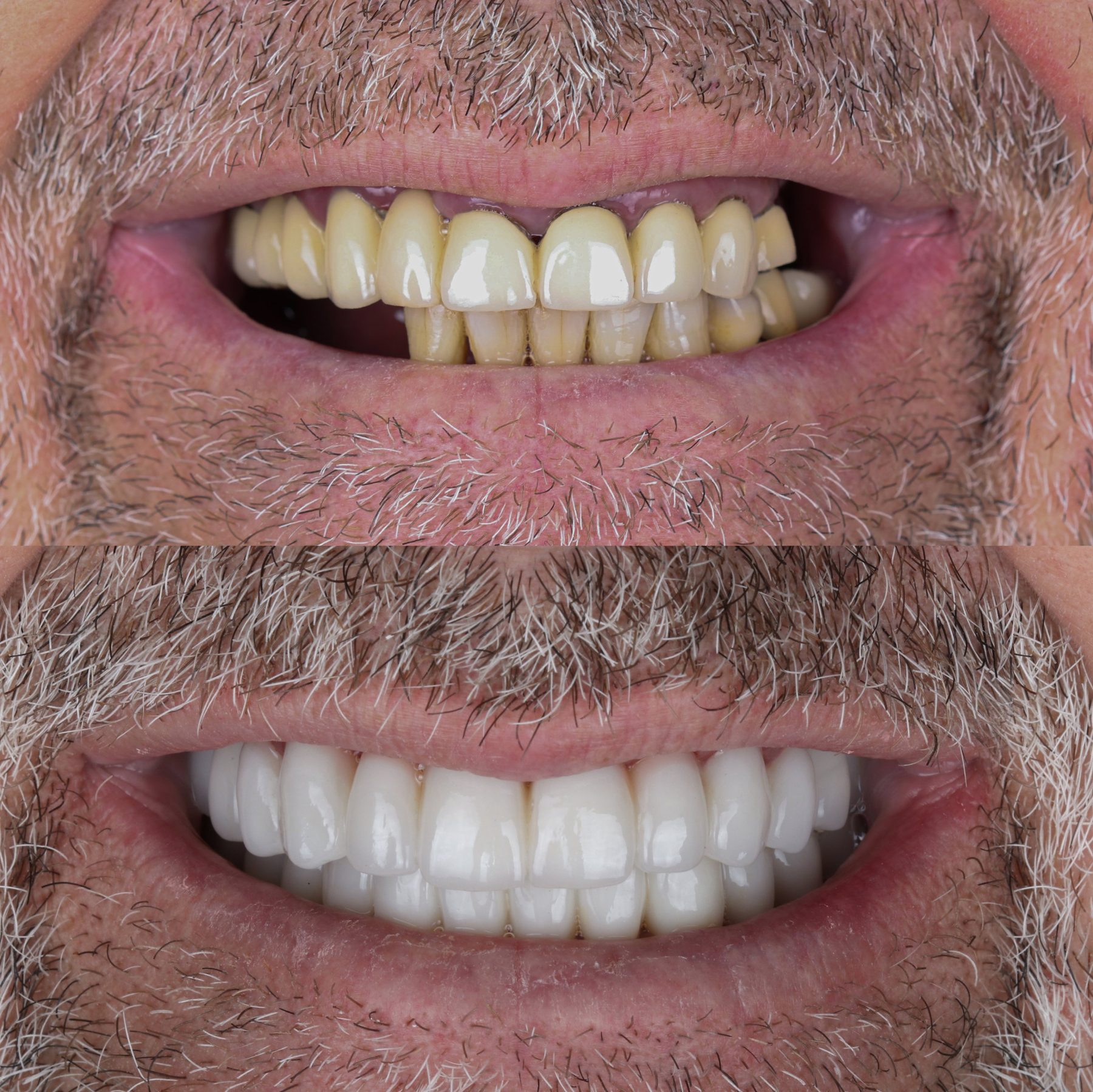 Real Island Dental full-arch implant patient before and after