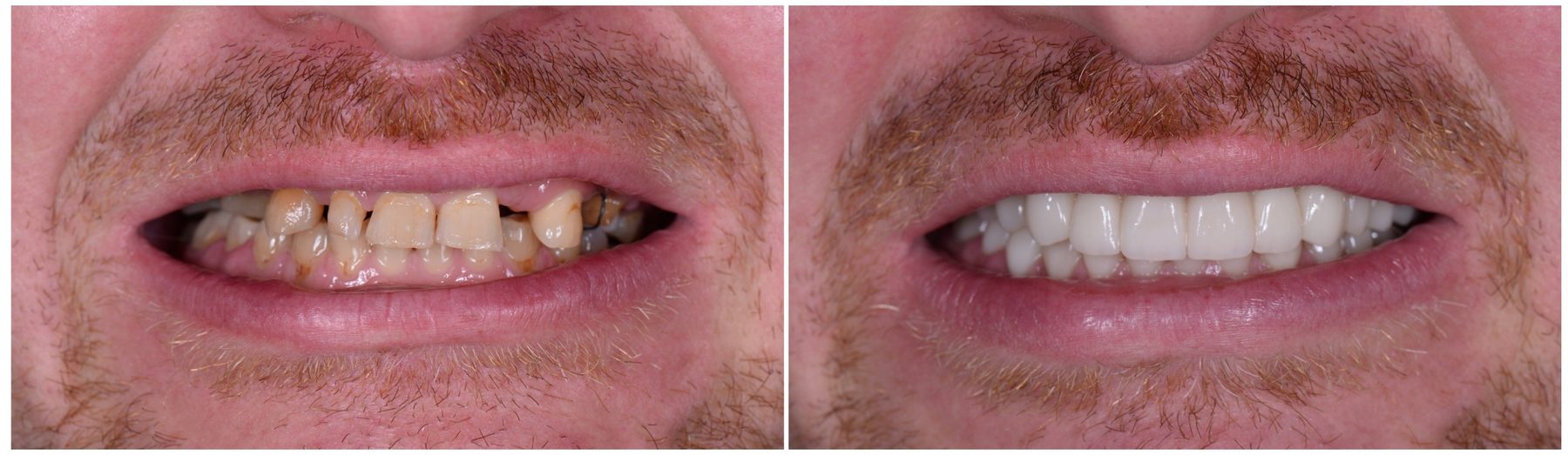 Island Dental full-arch implant patient before and after
