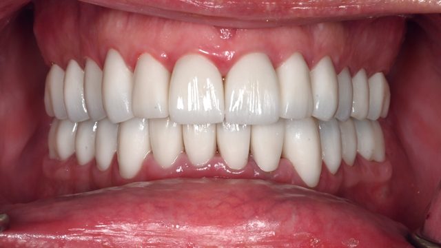 Full-mouth zirconia restoration