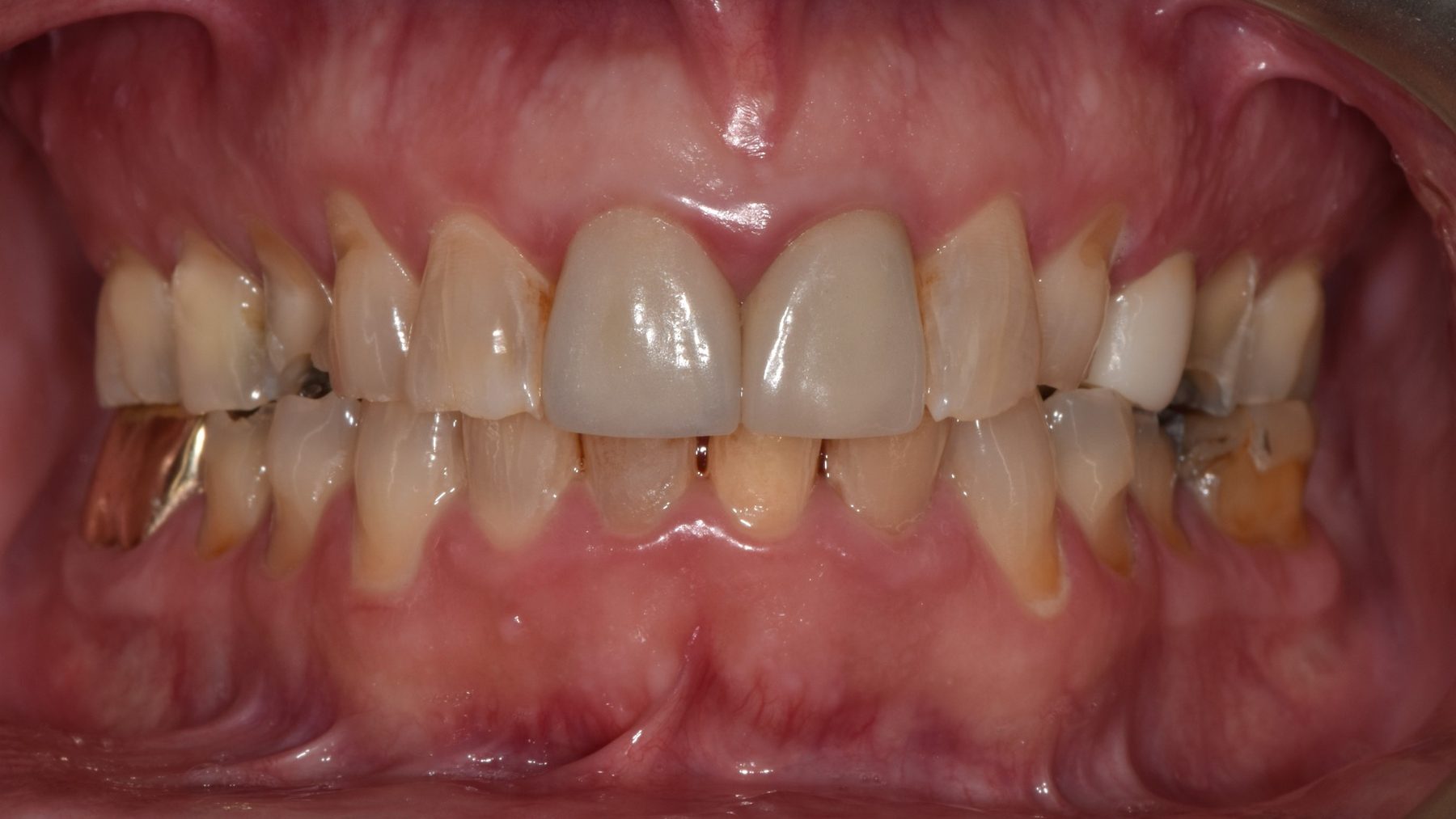 Worn, failing teeth before treatment