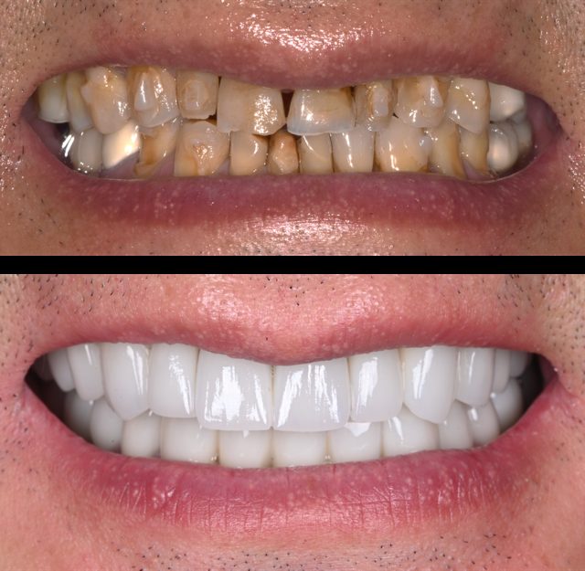 Before and after: full-mouth zirconia implant bridge made at Island Dental