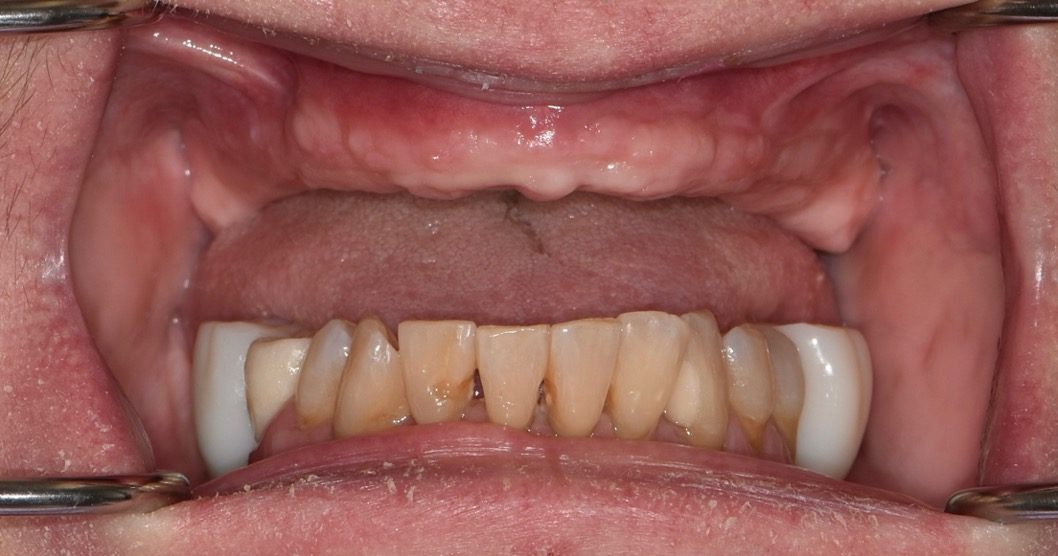 Failing upper arch before treatment