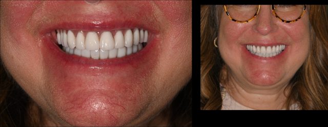 Island Dental patient smiling with her same-day denture